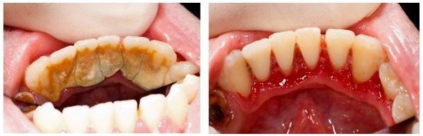 dental calculus before and after